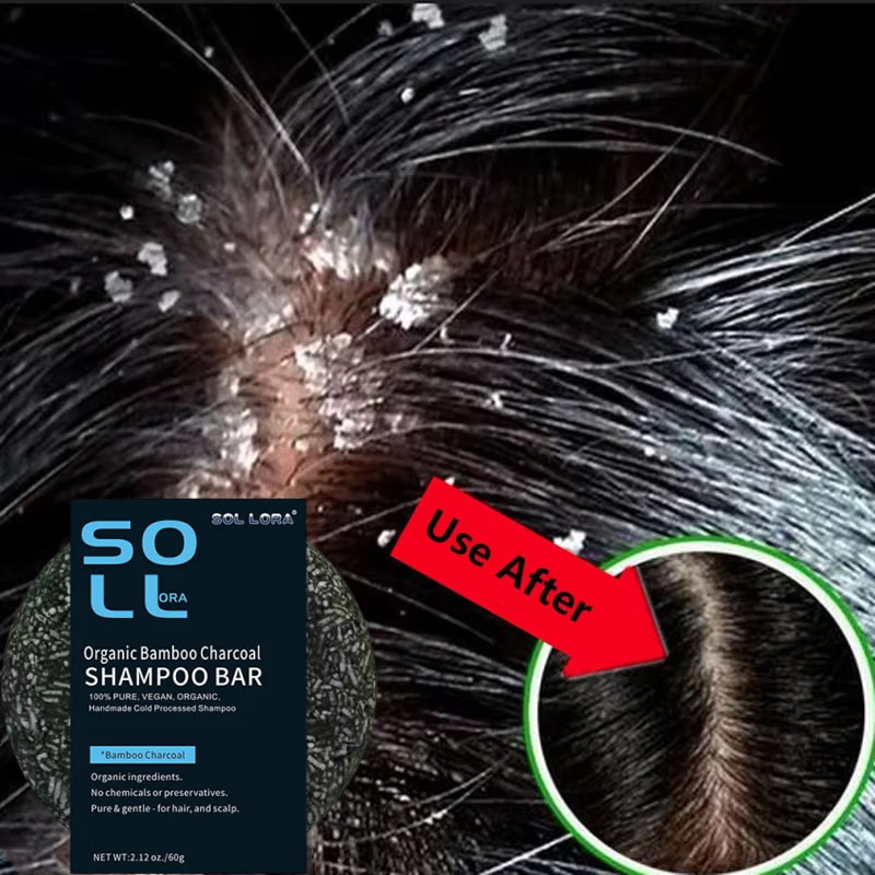 Schnelle Anti-Schuppen-Haarbeh – Hair Care Dandruff Bewertung und Preis